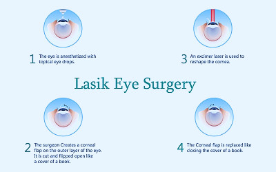 LASIK Eye Surgery Near Boynton Beach & Lake Worth, FL